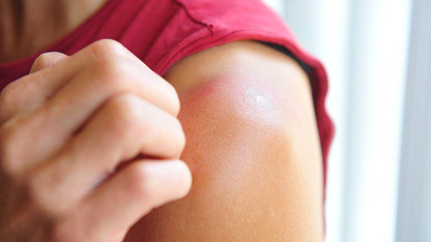 How to Heal Burned and Peeling Skin