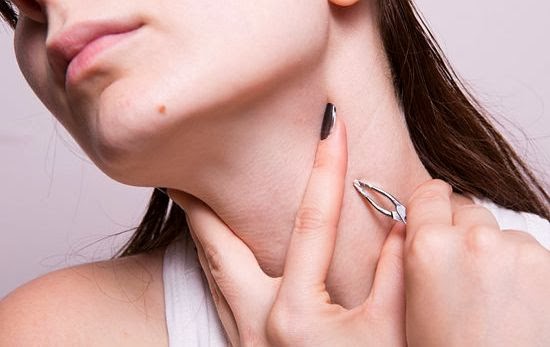 Home Remedies to Get Rid of Skin Tags