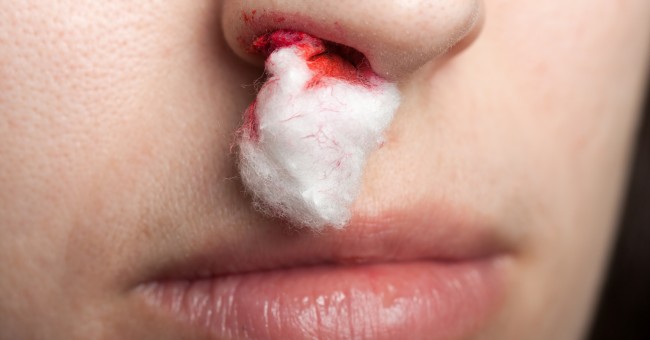 Home Remedies to Treat Bleeding Nose
