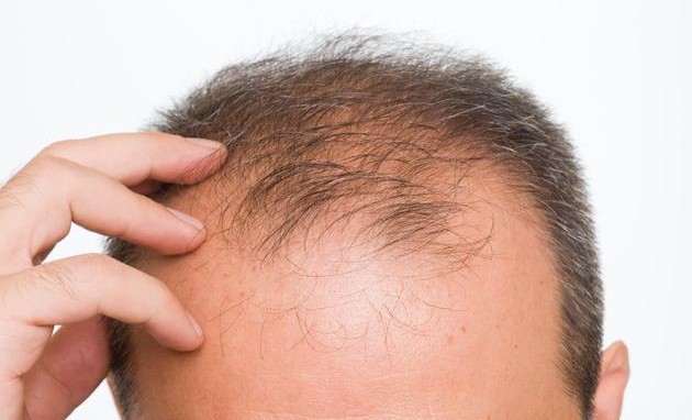 Home Remedies to Treat Baldness