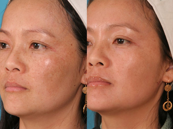 How Fraxel Laser Treatment Improves Skin