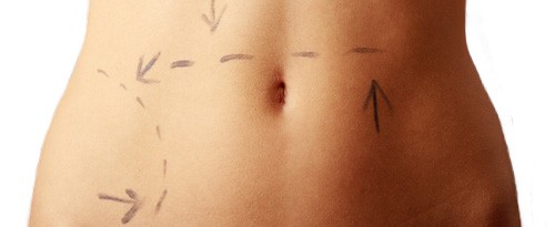Understanding the Differences Between SmartLipo and Liposuction