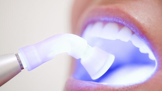 Can Teeth Whitening Really Damage Your Teeth