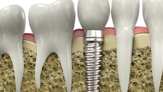 Senior Citizens 3 Reasons to Consider Getting Dental Implants