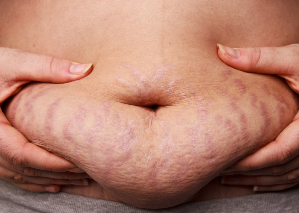 Reasons Behind Stretch Marks and its Solutions
