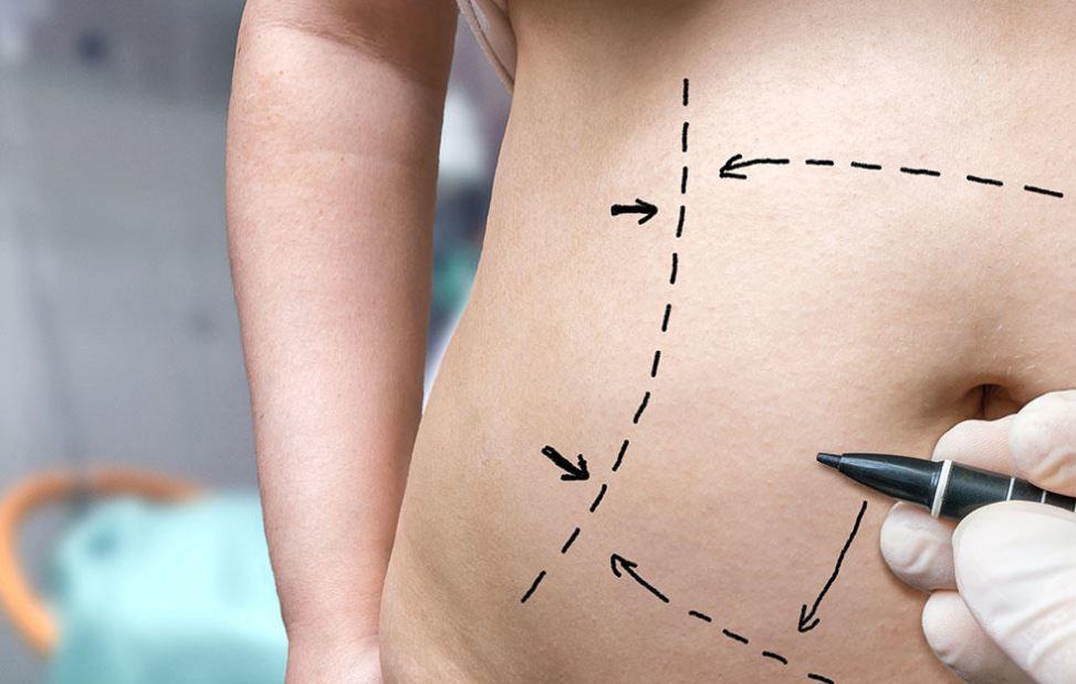 Slimming Surgery Myths: 4 Common Misconceptions About Tummy Tucks