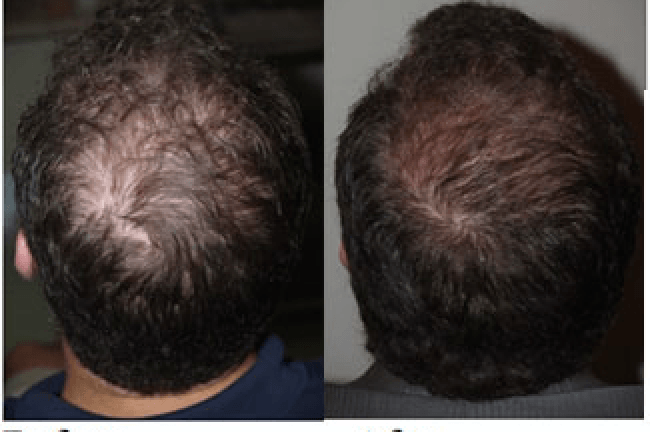 The best solution for your Hair Loss or Baldness- Hair Restoration With PRP Therapy
