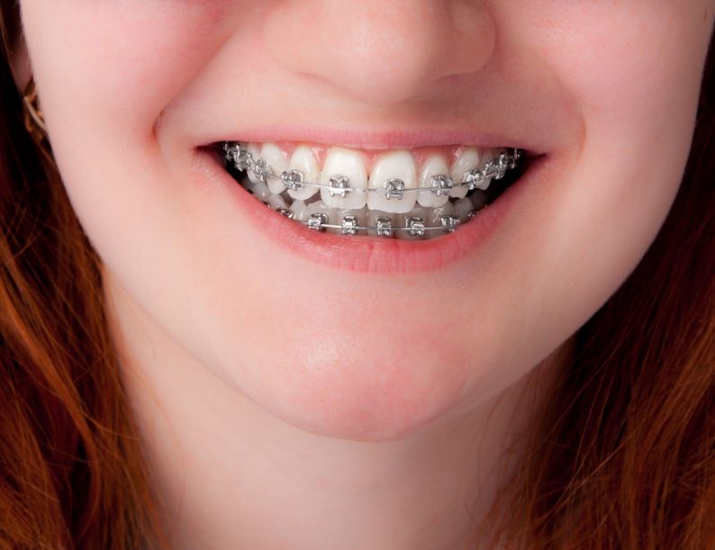 Straight Smiles Why Your Kids Need Braces