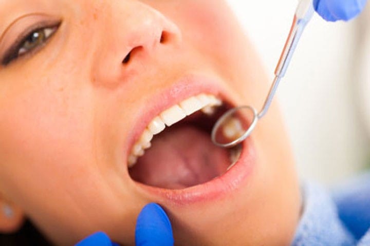 Why Dentists Have Moved away from Using Metal Fillings