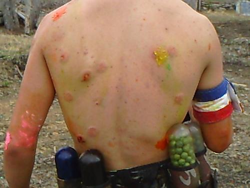 treatment for paintball welts