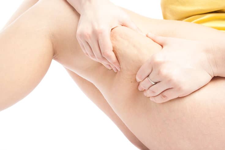 Is there a Permanent Solution to Cellulite?