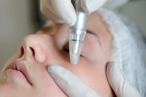 Microdermabrasion can remove marks of aging from the skin to make you look younger