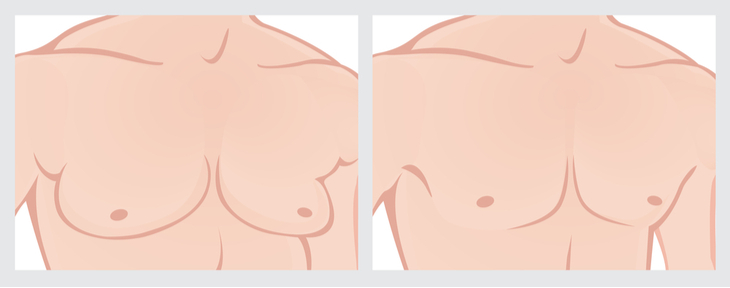 Is Male Breast Reduction Surgery Right for Me?