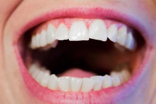 Porcelain or Composite Veneers: Which is Better?