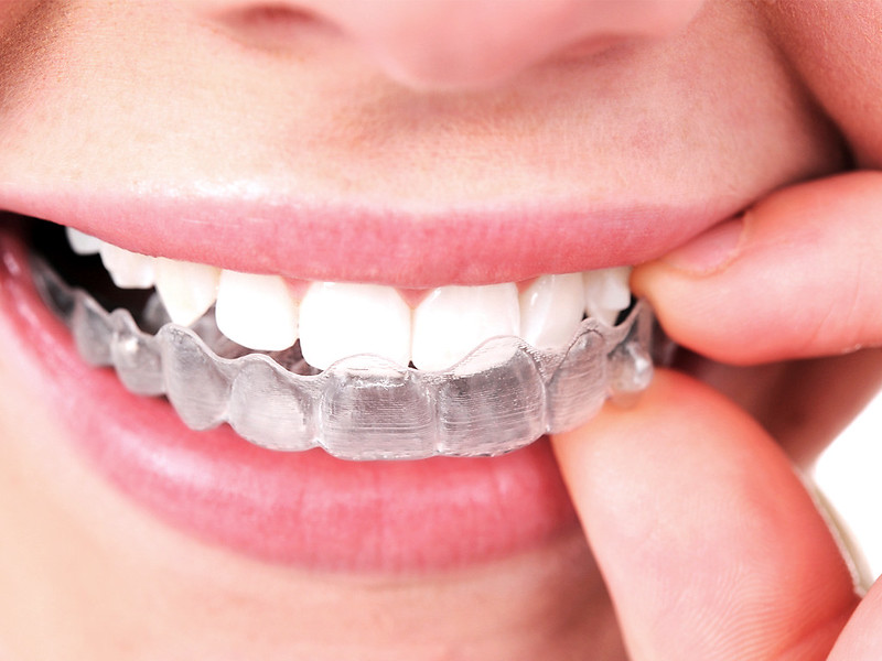 8 Things You Need to Know About Invisalign