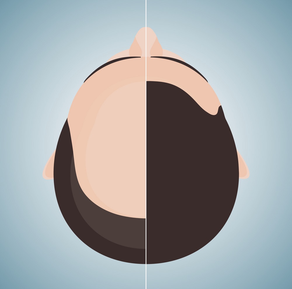 bald-man-before-and-after-hair-transplantation