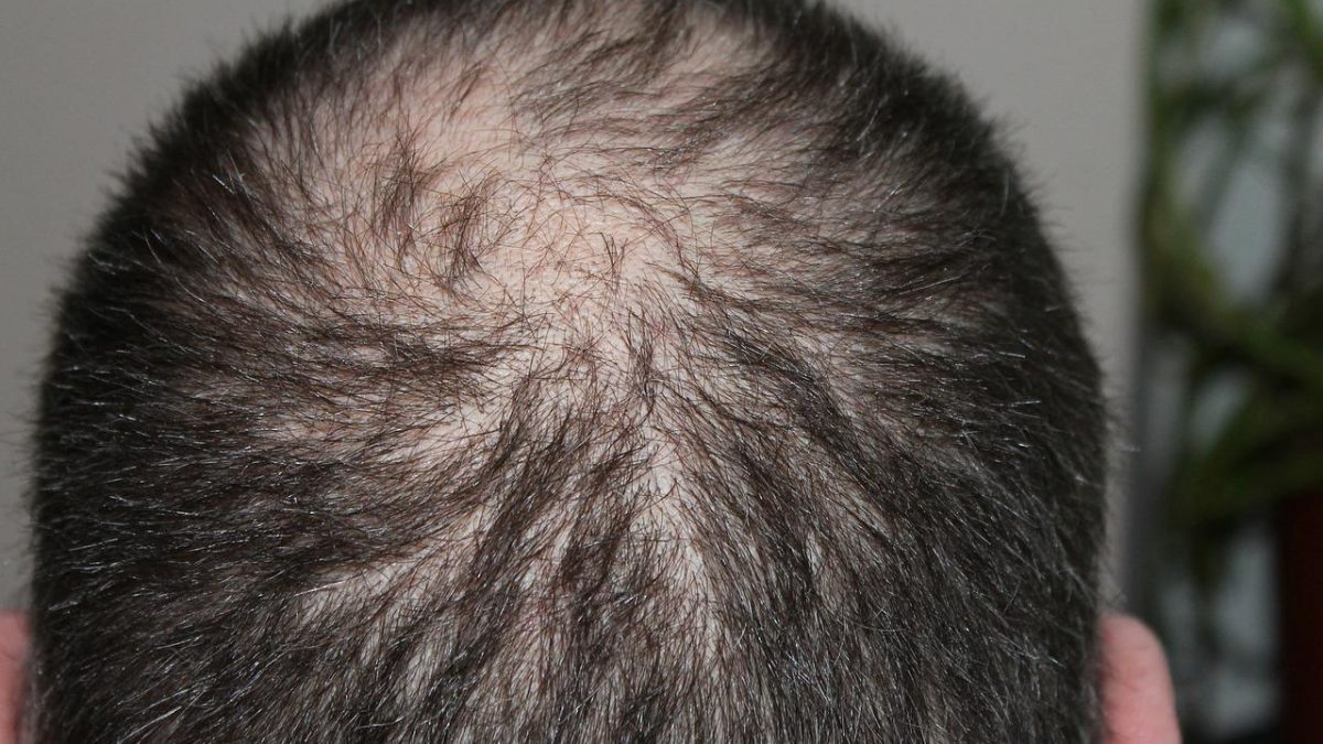 5 Best Blockers To Fight Hair Loss