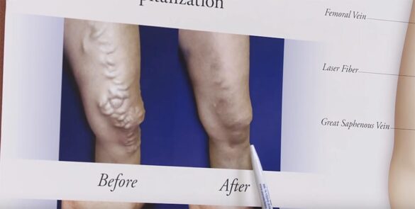 Varicose Vein Treatment and Radiofrequency Ablation